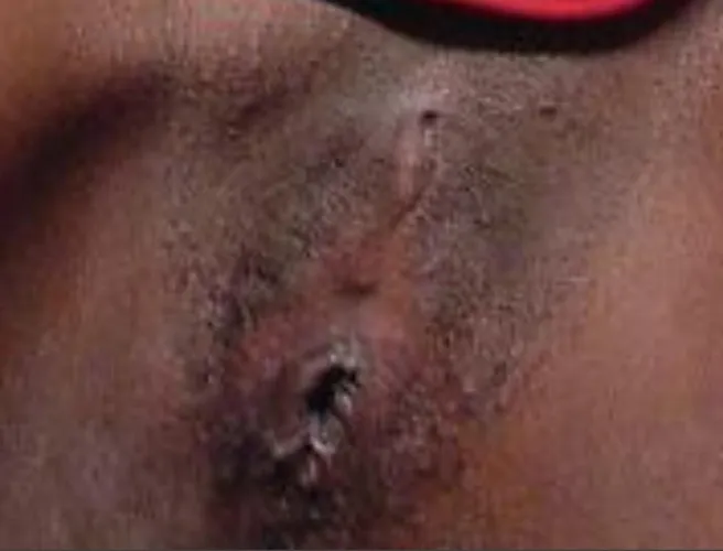 Beautiful lipless skin and hole Thumbnail