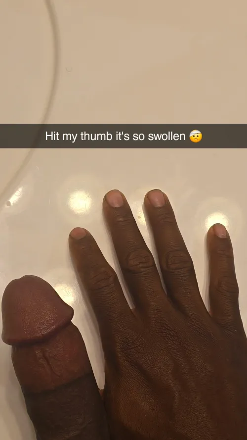 Thum is swollen 😫 Thumbnail
